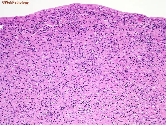 Histology of malakoplakia in the urinary bladder mucosa. Specimen: bladder mucosa biopsy from cystoscopy. Modality: light microscopy of H&E-stained sections. Morphology: sheets of large macrophages with abundant foamy, granular cytoplasm (von Hansemann cells) scattered among lymphocytes and plasma cells in the lamina propria; occasional multinucleated giant cells. Within macrophages, basophilic, calcium- and iron-containing inclusions (Michaelis–Gutmann bodies) may be seen, giving targets/granular calcific appearances. The background epithelium shows chronic cystitis with neutrophils and surface erosion. The histiocytes may be arranged in granulomatous nodules or diffuse infiltrates; plasma cells and fibroblastic reaction may be present. The pattern is an abnormal inflammatory response due to defective phagolysosome function in macrophages, resulting in undigested bacterial debris from organisms like Escherichia coli or Proteus mirabilis; common bladder involvement. Clinically, malakoplakia presents with frequency, dysuria, hematuria; cystoscopy reveals plaque-like or mass-like lesions mimicking neoplasia. Diagnostic significance: malakoplakia should be distinguished from bladder carcinoma; Michaelis–Gutmann bodies are pathognomonic but not always present. Potential clinical use cases: educational histopathology, differential diagnosis in elderly women with hematuria and chronic UTIs, guiding antibiotic therapy targeting intracellular bacteria. Correlation with urine culture and imaging aids in confirming infection-driven pathology. In research contexts, malakoplakia serves as a model of impaired intracellular digestion and macrophage dysfunction.