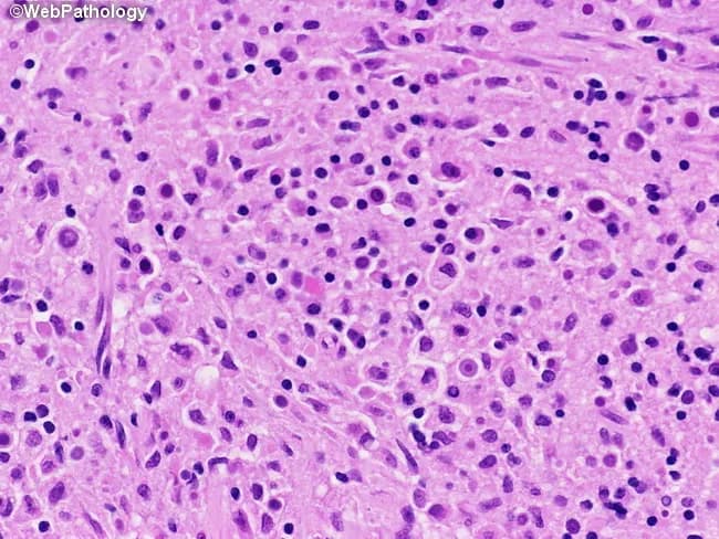 Light microscopy of a bladder tissue biopsy stained with hematoxylin and eosin (H&E) at high power (approximately 400x total magnification) demonstrates classic malakoplakia of the urinary bladder. The lamina propria and overlying urothelium contain numerous foamy, granular histiocytes (von Hansemann cells) characterized by abundant eosinophilic cytoplasm and eccentric, round to oval nuclei. Within the histiocytes and in the interstitial space, basophilic, targetoid inclusions are visible: Michaelis–Gutmann bodies, laminated calcium phosphate deposits surrounding bacterial remnants. These Michaelis–Gutmann bodies appear as centripetally layered, bull’s-eye–like structures and can be highlighted by special calcium stains (e.g., von Kossa) or demonstrated with periodic acid–Schiff when necessary; their presence is diagnostic for malakoplakia. The inflammatory background is mixed, with scattered lymphocytes and plasma cells, and occasional multinucleated giant cells forming a granulomatous milieu. Clinically, malakoplakia reflects impaired macrophage bactericidal function often in the setting of chronic bacterial infection, most commonly Escherichia coli. The overall pattern mimics neoplastic processes and may present as a bladder mass or mimicking urothelial carcinoma; thus, recognition of von Hansemann cells and Michaelis–Gutmann bodies is essential for accurate diagnosis. This image supports teaching, differential diagnosis, and research on macrophage lysosomal storage-like disorders and infectious granulomatous inflammation in the genitourinary tract for education.