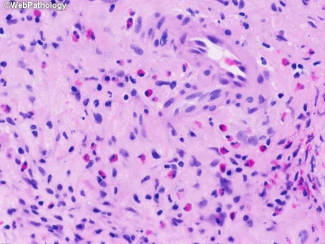 Histopathology: Light microscopy of a gastrointestinal mucosal biopsy stained with Hematoxylin and Eosin reveals a dense inflammatory infiltrate within the lamina propria. The predominant cellular population comprises eosinophils, characterized by bilobed or irregular nuclei and abundant bright pink cytoplasmic granules, intermixed with a smaller number of mononuclear lymphocytes. Epithelial architecture within this field shows intact surface epithelium without definite crypt distortion or ulceration; no granulomas or conspicuous vasculitis are evident in the sampled area. The surrounding stroma appears mildly edematous with scattered plasma cells and occasional neutrophils. In this image, the eosinophilic infiltrate is conspicuous and may extend around mucosal glands and vessels. Such a pattern is compatible with eosinophilic gastroenteritis or hypersensitivity reactions and could reflect parasitic infection, drug-induced hypersensitivity, or food allergy, depending on clinical context. Normal variant eosinophil counts in the lamina propria can be elevated in the GI tract; therefore correlation with peripheral eosinophilia and clinical symptoms is essential. Diagnostic significance: the presence of tissue eosinophilia in the lamina propria supports a non-neoplastic inflammatory process; differential diagnoses include eosinophilic colitis/enteritis, inflammatory bowel disease with eosinophilia, or secondary eosinophilia due to parasites. Clinical correlation with symptoms (abdominal pain, diarrhea), stool studies, and serologies is recommended.