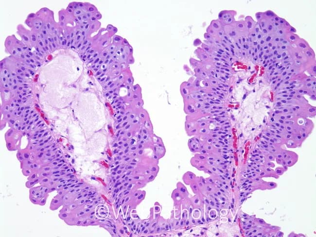 Light microscopy of hematoxylin and eosin stained small intestinal mucosa, prepared as longitudinal sections, displaying the mucosal folds or villi characteristic of the jejunal/ileal region. Each villus presents a tall, brush-border–bearing epithelium with basally positioned nuclei in enterocytes and scattered goblet cells producing mucin. The apical surface is densely stained, while goblet cells appear pale to vacuolated. The villous cores comprise loose lamina propria with scant capillaries and occasional lymphocytes, and a thin muscularis mucosae underneath is not readily resolved at this magnification. The overall architecture is preserved, with uniform crypts at the base, no crypt hyperplasia, and no plasmacytosis or lymphocytic infiltrate. There is no submucosal edema or inflammatory exudate; vessels and stromal tissue appear normal, and there is no evidence of villous blunting or villous atrophy. These features correspond to normal mucosal histology of the small intestine in health or in control specimens. This image serves as a reference standard for educational comparison, enabling recognition of normal mucosal architecture and the distinction from enteropathies such as celiac disease, inflammatory bowel disease, infectious enteritis, or malabsorption syndromes. It can assist in diagnostic training, multidisciplinary case discussions, and slide-based pathology curricula, and provides a baseline for morphologic correlation with clinical symptoms and laboratory tests.