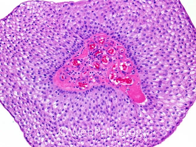 This is a brightfield light microscopy histology image of a renal cortex region, captured after standard hematoxylin and eosin staining. The primary subject is a renal glomerulus embedded in renal cortex, with Bowman's capsule and adjacent proximal/distal tubules visible in the peripheral parenchyma. The glomerular tuft consists of a dense network of capillary loops; erythrocytes appear as circular red cells within the capillary lumina, giving a pink-reddish core. The surrounding mesangial cells and basement membranes are discernible as pink-stained stroma, with purple-nuclei of endothelial and parietal epithelial cells. The tubules exhibit cuboidal epithelium with basophilic nuclei and clear luminal spaces. Overall architecture demonstrates typical renal cortical histology: a lobulated arrangement of tubules around a central tuft, with intact Bowman's capsule juxtaposed to the capillary network. There is no conspicuous sclerosis, crescents, or inflammatory infiltrates; no overt tubular atrophy or interstitial fibrosis evident. This image represents normal renal histology suitable for educational purposes and serves as a reference for pattern recognition. Clinically, it aids in teaching glomerular structure, filtration barrier components (endothelium, basement membrane, podocytes), and nephron organization. Potential use cases include medical education, comparative pathology, and radiology-pathology correlation studies for nephrology and urology training.