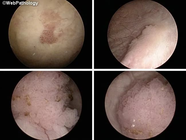 Flexible office-based cystoscopy using a pliable cystoscope under white-light illumination provides in vivo visualization of the urothelium. In these four quadrants, papillary, frond-like lesions rise from a background of smooth, regular urothelial lining in the urinary bladder. The lesions exhibit irregular, pedunculated or sessile architecture with variable color—from pale pink to slightly erythematous—often with delicate vascularity at the surface. The surrounding mucosa remains intact and non-ulcerated in the absence of obvious invasion, though focal necrosis or a broad-based, sessile component would raise concern for higher-grade disease. The endoscopic appearance alone cannot establish histology; histopathologic confirmation via biopsy is required to differentiate benign inflammatory processes from urothelial carcinoma and to determine grade and stage. Endoscopic assessment is essential for lesion localization, resection planning, and surveillance, with biopsy targets typically chosen at the most prominent papillary fronds or suspicious necrotic areas. Clinically, these findings prompt to perform transurethral resection with intravesical therapy if indicated, and staged evaluation to assess invasion depth. In summary, cystoscopy detects papillary urothelial tumors, supports risk stratification (papillary vs sessile; necrotic tendency), and guides diagnostic workup in bladder cancer management, including urothelial carcinoma, non-invasive papillary carcinoma, carcinoma in situ, and inflammatory/benign mimics.