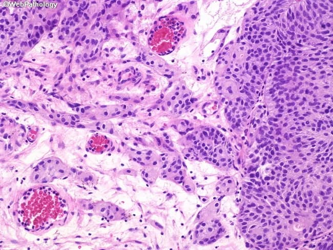 Imaging modality: Brightfield light microscopy of a hematoxylin and eosin (H&E) stained bladder mucosa section. Anatomical context: urinary bladder urothelium with invasion into the lamina propria; muscularis propria is not involved. The histology shows urothelial carcinoma arranged in nests, cords, and clusters at the base of the lesion, with invasion into the subepithelial lamina propria. Individual tumor cells and small clusters are embedded within desmoplastic stroma and peritumoral inflammatory infiltrate. Cytology is predominantly high-grade with marked nuclear pleomorphism and hyperchromasia, though occasional fields may exhibit lower-grade cytology. The lesion lacks invasion of the muscularis propria (pathologic stage T1); the surrounding muscularis shows no tumor cell infiltration. Pathologic interpretation: urothelial carcinoma with lamina propria invasion (T1), a non–muscle-invasive but higher-risk subset, often associated with recurrence and progression risk. Management decisions include intravesical therapies (e.g., BCG) and surveillance, with cystectomy reserved for select higher-grade or unresponsive cases. Diagnostic significance and staging context emphasize lamina propria invasion as a key prognostic factor. Differential considerations include Ta urothelial carcinoma without invasion and carcinoma in situ when deeper invasion is not demonstrated. This image is valuable for educational and research purposes in bladder cancer histopathology, staging, and pathology-to-clinical-management correlations.