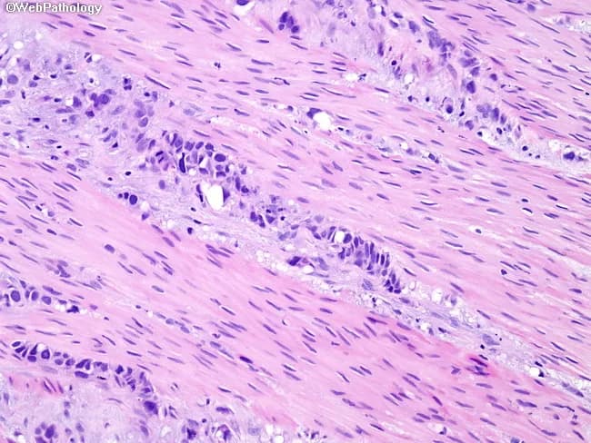 This is a histopathology image of a bladder wall biopsy or cystectomy specimen prepared with Hematoxylin and Eosin staining. The tissue shows detrusor muscle fibers (detrusor = muscularis propria) interspersed with nests and single cells of urothelial carcinoma invading into the muscularis propria. The malignant cells exhibit high-grade cytology: marked nuclear pleomorphism, hyperchromasia, and conspicuous nucleoli, with frequent mitotic figures. The interface between urothelial tumor and smooth muscle is irregular, with tumor infiltration extending among the smooth muscle fascicles. In some regions, muscularis propria appears disrupted by tumor cords, while surrounding stroma shows a desmoplastic response. The overlying urothelium demonstrates variable atypia; there is no definitive invasion of mucosal layers evident in this field, but the critical observation is deep invasion into the detrusor muscle, consistent with muscle-invasive bladder cancer. Clinically this finding has major implications: staging as pT2, guiding definitive therapy decisions such as radical cystectomy, systemic chemotherapy, or radiotherapy, and prognosis. In equivocal sections, pathologists reserve judgment and recommend resampling or re-cutting to confirm muscularis propria invasion. This image supports the diagnoses of muscle-invasive urothelial carcinoma and underscores the necessity for precise depth of invasion reporting and multidisciplinary clinical correlation.