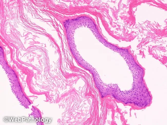 Low-power brightfield light microscopy of a formalin-fixed, paraffin-embedded arterial cross-section stained with Hematoxylin and Eosin. The specimen shows a circular vessel with a well-defined, multilayered wall. The lumen is patent and lined by a narrow endothelial layer. The tunica media exhibits concentric layers of eosinophilic smooth muscle cells and occasional nuclei aligned along the wall, giving a dense, pink stippled appearance. The internal elastic lamina is not clearly resolved at this magnification. The tunica adventitia is relatively inconspicuous with sparse connective tissue. There is no overt atheromatous plaque, calcification, hemorrhage, or inflammatory infiltrate noted. Overall architecture is preserved, suggesting a normal or nonpathologic arterial segment. This image is suitable for illustrating normal vascular histology and can serve as a reference for comparison with arteriosclerotic lesions in teaching, research, and diagnostic practice. Potential clinical utility includes training in recognition of arterial layering, identifying pathologies such as atherosclerosis, vasculitis, and aneurysm formation, and correlating histology with imaging findings from ultrasound or CT angiography. The dataset supports queries for vascular histology, arterial wall ultrastructure, smooth muscle organization, and H&E staining patterns in a cross-sectional artery. The image exemplifies typical histologic cues used in vascular pathology curricula and can anchor comparative discussions of disease progression and treatment implications.