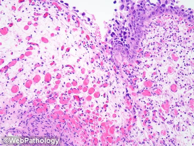 Histopathology: Bladder mucosa illustrating urothelial carcinoma in situ with prominent tumor-induced neovascularization of the lamina propria. Hematoxylin and eosin (H&E) stained section shows an intact urothelium overlying a richly vascular lamina propria, with conspicuous capillary proliferation and inflammatory infiltrates, consistent with mucosal erythema seen cystoscopically. The urothelial layer exhibits high-grade cytologic atypia, including enlarged, hyperchromatic nuclei, increased nuclear-to-cytoplasmic ratio, pleomorphism, and frequent atypical mitoses confined to the basal and intermediate layers, without overt invasion into muscularis propria. Mucosal edema and mild edema-related vascular congestion accompany chronic inflammatory cells, including lymphocytes and plasma cells. The combination of neovascularization and dysplastic urothelium is characteristic of carcinoma in situ, or high-grade urothelial intraepithelial neoplasia, and correlates with the erythematous, velvety appearance observed during cystoscopy. Inflammation likely augments vascular density and mucosal visibility. Clinically, CIS carries a high risk of progression to invasive disease and warrants intravesical therapy and close surveillance. This image represents a biopsy specimen suitable for histologic confirmation, referral to urothelial pathology, and integration with cytology and imaging for comprehensive staging. Accurate recognition of angiogenic changes supports diagnosis, guides treatment selection, and informs prognosis in bladder cancer management. Histology corroborates cystoscopic findings and cytology, enabling precise therapeutic planning and improved outcomes.