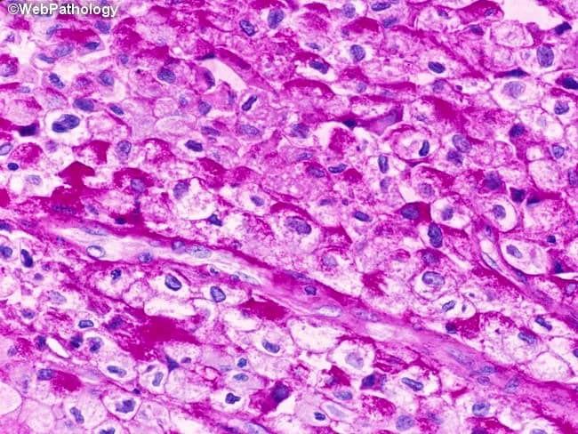 High-fidelity histopathology image captured with brightfield microscopy of a bladder mucosa biopsy stained with Periodic acid–Schiff (PAS). The tumor displays urothelial cells with abundant clear cytoplasm due to glycogen accumulation, characteristic of the clear cell variant of urothelial carcinoma. Cells are arranged in solid sheets and irregular nests within the urothelial/lamina propria region, with nuclear atypia including enlarged, hyperchromatic nuclei and conspicuous nucleoli. The PAS positivity highlights cytoplasmic glycogen; this reaction is typically diastase-labile (glycogen) and may require diastase treatment to confirm glycogen as the staining source (not shown). The tumor cells often border around a fibrovascular stroma, with occasional mitotic figures and occasional inflammatory infiltrates. The differential includes other glycogen-rich clear cell neoplasms and metastasis; immunohistochemical workup (e.g., GATA3, uroplakin, p63) supports urothelial origin while ruling out clear cell renal cell carcinoma. Clinically, this histology correlates with bladder mass lesions in adults and informs prognosis and treatment decisions, including cystectomy or intravesical therapy depending on invasion. This image demonstrates typical features of clear cell urothelial carcinoma, including glycogen-rich cytoplasm, clear cell morphology, and urothelial differentiation markers in adjunct studies. Correlation with imaging and flow cytometry may further refine staging; pathologist interpretation relies on morphological context and corroborative IHC profiles.