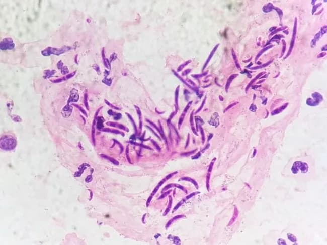 A light microscopy image obtained from a urine cytology slide stained with a fungal stain (e.g., lactophenol cotton blue) demonstrates numerous fusiform to sickle-shaped macroconidia with 1 to 4 septa, embedded in a refractile background. The macroconidia are slender, curved, and multi-septate, consistent with Fusarium species, most commonly F. solani, F. oxysporum, or F. moniliforme. Occasional hyphal elements may be seen, but the diagnostic hallmark in this preparation is the characteristic banana-shaped spindle-like conidia with multiple internal septa. This morphology supports a diagnosis of fusariosis involving the urinary tract in an adult male with chronic liver disease; the clinical history notes hematuria and negative urine cytology for malignant cells, highlighting an infectious etiology rather than neoplasia. Fusarium is a filamentous, hyaline fungus widely distributed in soil and plants in tropical and subtropical climates and is an important opportunistic pathogen in immunocompromised hosts. It is associated with keratitis, endophthalmitis, onychomycosis, burn wound infections, catheter-related fungemia, and, less commonly, urinary tract infections. Morphologic identification on cytology or histopathology is vital for rapid diagnosis. Clinically relevant terms include fungal keratitis, sinusitis, disseminated fusariosis, amphotericin B therapy, voriconazole susceptibility, and drug resistance. This image is valuable for educational reference, differential diagnosis of septate hyaline molds, and microbiology/pathology training.
