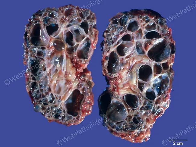 Gross pathology photograph of bilateral kidneys displaying classic autosomal dominant polycystic kidney disease (ADPKD) morphology. The organs are enlarged, yet retain their reniform shape. Longitudinally sectioned cut surfaces reveal numerous variably sized cysts that dissect the renal parenchyma and are separated by only a scant amount of residual cortex and medulla. Cysts range from tiny, sub-centimeter ducts to large, fluid-filled compartments; walls appear thin and translucent, and the cysts are often filled with clear or straw-colored fluid. The remaining parenchyma is markedly thinned, with loss of normal cortical architecture and parenchymal compression by the extensive cystic burden. This macroscopic pattern is characteristic of ADPKD, reflecting underlying genetic mutations (PKD1 or PKD2) and progressive replacement of functional nephrons by cysts. Diagnostic significance lies in correlating with bilateral nephromegaly, diffuse cortical-medullary cystic disease, and potential progression to chronic kidney disease and hypertension. Clinical relevance includes anticipation of renal insufficiency, risk of berry aneurysms in some patients, and the need for surveillance for extrarenal manifestations. Potential educational use includes teaching gross morphologic criteria for ADPKD, differential diagnosis versus ARPKD, and correlation with imaging modalities such as ultrasound, CT, and MRI. These features underscore ADPKD pathophysiology.