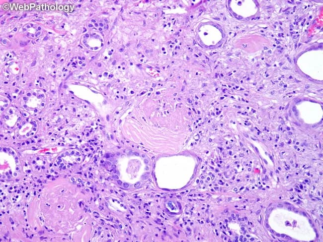 Light microscopy of formalin-fixed, paraffin-embedded renal parenchyma stained with Hematoxylin and Eosin shows advanced chronic cystic kidney disease consistent with Autosomal Dominant Polycystic Kidney Disease (ADPKD). The cortex and outer medulla are disrupted by cysts of varying size, separated by pronounced fibrous stroma. Interstitial fibrosis replaces normal tubular architecture, and several glomeruli are sclerotic with hyalinization of their tufts and thickened basement membranes. Arterioles and small arteries exhibit hyaline arteriolosclerosis with luminal narrowing, contributing to ischemic tubular injury. Tubular atrophy with thickened basement membranes and dilated, atrophic tubules line the interstitium. Calcific deposits are present within the interstitium or cyst walls near the periphery of fibrotic tissue. A chronic inflammatory infiltrate, dominated by lymphocytes and plasma cells, is intermixed with the fibrotic matrix. The overall pattern reflects long-standing nephron loss with compensatory hyperplastic changes in remaining nephrons. This histology supports the diagnosis of polycystic kidney disease and correlates with progressive renal dysfunction. Clinically, such tissue findings align with ADPKD severity, often accompanied by hypertension and risk of renal failure; differential considerations include other cystic diseases and chronic nephritis. The image exemplifies characteristic cyst-induced parenchymal remodeling and vascular compromise that underlie reduced glomerular filtration rate. These features are typical of late-stage disease.