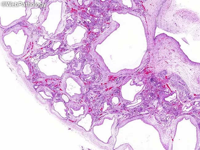 This is a histopathology image of a multicystic dysplastic kidney. The specimen comprises renal tissue examined by light microscopy after hematoxylin and eosin staining, viewed under bright-field illumination. The cortex and medulla architecture are disrupted by variably sized cysts lined by cuboidal to flattened epithelium; the renal parenchyma is disorganized with immature elements lacking orderly nephrogenesis. The intervening stroma contains primitive tubules and ducts embedded in a fibromuscular matrix, with collars of poorly differentiated smooth muscle cells encircling primitive ducts. The stroma also contains thick-walled vessels, lymphatics, and peripheral nerves; metaplastic cartilage is present in about 30% of cases but is not required for diagnosis. Overall, this pattern reflects disordered nephrogenesis and dysplastic development, rather than neoplastic transformation. Diagnostic significance rests on the combination of non-communicating cysts, immature renal elements, and periductal smooth muscle collars; absence of mature glomeruli and organized nephron units helps distinguish from Wilms tumor, cystic nephroma, hydronephrosis, and other cystic renal lesions. Clinically, these findings correlate with a nondominant or nonfunctional renal unit and potential contralateral compensatory hypertrophy; in infancy, unilateral disease is common and management ranges from observation to nephrectomy. Correlating imaging with histology aids prognosis and guides multidisciplinary pediatric nephrology decisions in clinical practice.