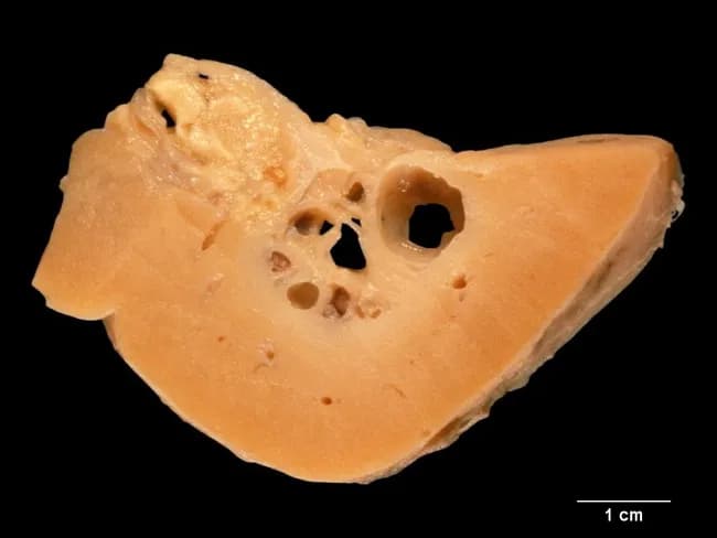 Gross pathology image of a renal tissue specimen showing a cross-section through the renal medullary region. The cut surface reveals numerous round to ovoid cystic-appearing spaces embedded within a tan-orange parenchyma, giving a sponge-like architecture consistent with dilated collecting ducts in the renal medulla. The cortex appears relatively preserved with no large focal necrosis or mass effect. The cavities are irregular in size but show a radial distribution toward the papillary tips, suggestive of medullary collecting duct dilation. The overall impression is compatible with medullary sponge kidney (MSK), a congenital malformation of the collecting system. MSK is usually bilateral, slightly more common in males, and frequently clinically silent; symptoms—when present—include nephrolithiasis, hematuria, and recurrent infection, typically in the third to fifth decades. The condition is often sporadic (~95%), with a genetic predisposition suspected in about 5% of cases. Associations include congenital hemihypertrophy, Beckwith-Wiedemann syndrome, Ehlers-Danlos syndrome, Wilms tumor, and multiple endocrine neoplasia type II. Clinically, recognition of this pattern informs differential diagnoses of medullary calcifications and recurrent stones and guides imaging follow-up with CT urography or MRI. This specimen highlights the distinctive medullary sponge morphology relevant for education, radiology correlation, and surgical planning when symptomatic. Clinical history should be considered globally.
