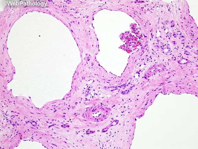 This is a light microscopy image of a hematoxylin and eosin (H&E) stained vascular cross-section. The specimen appears to be a muscular artery or arteriole embedded in loose connective tissue. The lumen is relatively round to oval and patent, with a pale, eosinophilic lumen border and surrounding concentric layers. The tunica media displays densely packed, spindle-shaped smooth muscle cells with eosinophilic cytoplasm arranged in parallel bundles. The internal elastic lamina is not clearly delineated at this low magnification, while the adventitia contains sparse connective tissue and scattered inflammatory cells. The vascular wall demonstrates intact architecture without obvious dissection, necrosis, or thrombosis. Cytologic atypia is absent in the wall, and there is no evident marrow-like or sinusoidal pattern. Extracellular matrix components—collagen fibers—are visible in the adventitia, contributing to wall rigidity. The image highlights normal histologic vascular morphology suitable for educational comparison with pathologic vessels showing vasculitis, atherosclerotic changes, or aneurysmal dilation. Clinically, this morphology supports differential diagnoses ranging from normal anatomic variation to early arteriosclerosis, depending on patient age and comorbidity. In research contexts, this slide serves as a reference standard for vessel wall histology and for developing image-recognition models in vascular pathology.