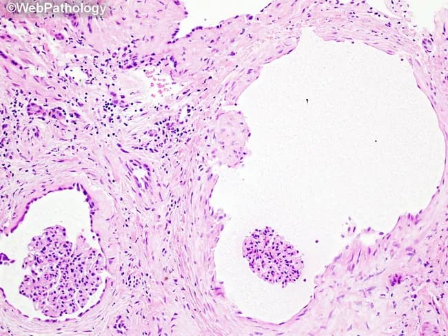 Renal histopathology slide imaged under light microscopy after Hematoxylin and Eosin staining. The primary subject is human kidney cortex tissue displaying a glomerulus and adjacent renal tubules. The specimen type is a renal biopsy. The orientation appears as a transverse section with a glomerular tuft in the left-lower quadrant and tubular profiles dispersed through the interstitium; a large luminal space on the right is a ductule or artifact. The glomerulus contains densely packed nuclei and mesangial regions; capillary loops are variably visible. Interstitial stroma shows mild cellularity without confluent inflammatory infiltrate. Overall architecture is preserved with no overt necrosis, crescents, or significant sclerosis evident at this magnification. The stain highlights nuclei in deep purple and extracellular matrix in pink, with clear delineation between glomerular structures, tubules, and interstitium. Clinically, such a field could serve as baseline for diagnosing glomerular diseases, evaluating tubular integrity, and assessing nephron units in nephritis workups. Potential diagnostic considerations include primary glomerular disease, reactive changes, or incidental normal renal histology depending on clinical context. This image is educational for pathology residents and medical students to recognize basic renal microanatomy and H&E contrast characteristics. This representation supports familiarity with renal histology, including glomeruli, tubules, and vessels architecture