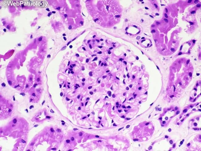 Renal biopsy histology image captured with light microscopy after Hematoxylin and Eosin staining. The section highlights a renal glomerulus embedded in renal cortex, with Bowman’s capsule clearly visible. Within the glomerulus there is marked cellular proliferation, with numerous densely packed nuclei suggestive of intraglomerular inflammation. A prominent cellular crescent occupies Bowman's space, formed by parietal epithelial cells and infiltrating leukocytes; this crescent partially compresses the capillary tuft. Surrounding tubulointerstitial tissue shows mild edema and scattered inflammatory cells. The basement membranes appear thickened in places, and there is focal endocapillary hypercellularity. Overall architecture suggests acute glomerular injury with crescent formation, compatible with rapidly progressive glomerulonephritis. The image serves as a morphologic correlate for nephritic syndrome and abrupt loss of renal function, guiding urgent diagnostic workup. Immunofluorescence and electron microscopy would assist etiologic classification (pauci-immune, anti-GBM, or immune complex), as would serologic testing for anti–neutrophil cytoplasmic antibodies, anti-GBM antibodies, and complements. Clinically, such histology is associated with rapidly progressive renal failure, hematuria, proteinuria, and hypertension. This representation supports differential diagnoses including anti-GBM disease, immune complex GN, and pauci-immune GN, and is valuable for education, research, and clinical correlation in nephrology. These features emphasize urgent management, biopsy interpretation, and multidisciplinary care planning strategies.