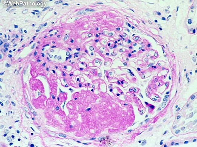 This is a histopathology image obtained with light microscopy from a formalin-fixed paraffin-embedded tissue section stained with Hematoxylin and Eosin. The field demonstrates a granulomatous inflammatory lesion, typically well circumscribed. The central area shows eosinophilic, acellular to granular necrotic material (caseous necrosis), surrounded by a dense mantle of epithelioid histiocytes with elongated, pale-staining nuclei and abundant pale cytoplasm. Multinucleated giant cells of the Langhans type may be present at the periphery. Scattered lymphocytes and occasional plasma cells form a peripheral lymphohistiocytic cuff around the granuloma. The surrounding stroma contains collagen fibers and occasional fibroblasts, with minimal additional inflammatory cells in this field. The morphology is classic for granulomatous inflammation, most commonly associated with infectious etiologies such as Mycobacterium tuberculosis or fungal infections, but can be seen in sarcoidosis or foreign body reactions depending on clinical context. Diagnostic significance: identification of a caseating granuloma raises suspicion for mycobacterial or fungal infection and warrants targeted microbiologic stains (Ziehl-Neelsen for acid-fast bacilli; GMS or PAS for fungi), cultures, and molecular testing. Clinical correlation is essential, including TB exposure history, immune status, and presentation—cough, weight loss, fever, pulmonary nodules or granulomatous lymphadenitis. This image is educational for teaching, differential diagnosis, and research into granulomatous disease pathology.