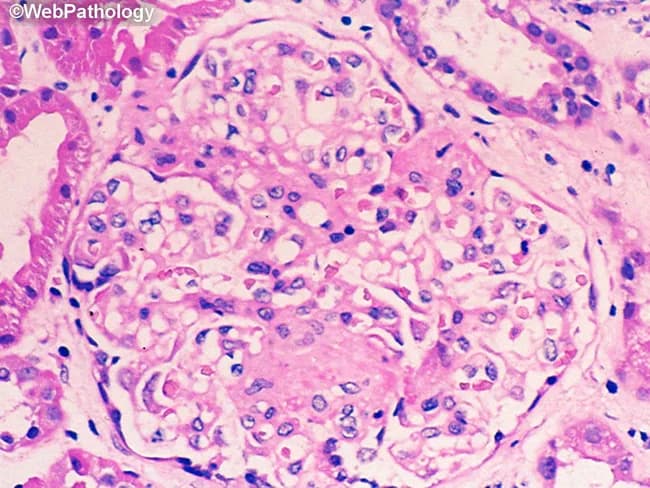 Imaging modality: Light microscopy (Hematoxylin and Eosin stain) of a renal cortical biopsy. Primary subject: renal glomerulus captured at high magnification (≈400x) showing a single glomerular tuft within the renal cortex. Visual features include crowded cellularity within the glomerular capillary loops and increased mesangial cell population, with indistinct capillary lumina due to cellular proliferation. The surrounding parenchyma shows mild tubulointerstitial involvement with scattered inflammatory cells; however, the main focus remains the glomerulus. The mesangial matrix appears variably expanded; there is no obvious crescents, fibrin deposition, or global sclerosis at this field of view. Background stroma is eosinophilic consistent with hematoxylin-eosin processing. Notable features such as endocapillary proliferation may indicate an inflammatory glomerulonephritis, though the absence of definitive immune complex deposits cannot be assessed on H&E alone. Diagnostic significance: these findings raise suspicion for an acute proliferative or mesangial proliferative glomerulonephritis; correlation with immunofluorescence, electron microscopy, and clinical data is essential. Potential clinical use cases include evaluation of proteinuria, hematuria, reduced glomerular filtration rate, or nephritic syndrome; differential diagnoses include IgA nephropathy, post-infectious GN, lupus nephritis, membranoproliferative GN. This image is valuable for medical education and research on renal pathology, glomerular architecture, and inflammatory patterns in the kidney.