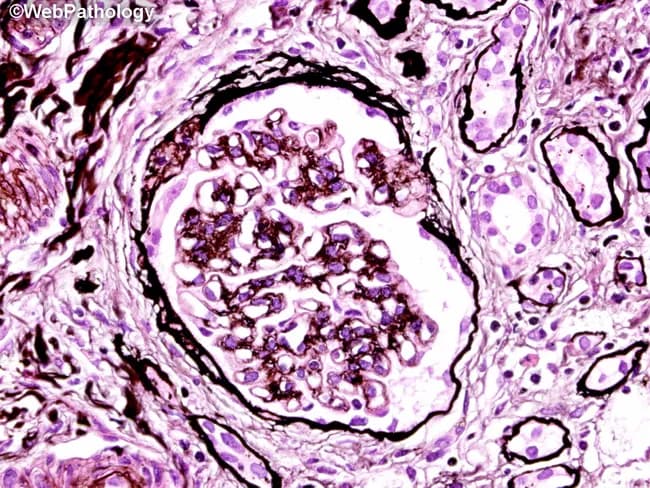 This is a high-fidelity histopathology image obtained from a human kidney biopsy, prepared as a routine H&E stained section and viewed under bright-field illumination at high magnification. The focal area centers on a renal glomerulus within the renal cortex; the cortical architecture surrounds the glomerulus with adjacent tubules and interstitium. The glomerular tuft exhibits marked cellularity with apparent endocapillary proliferation and crowding of capillary loops. Mesangial regions appear expanded with increased cellular elements. Intraluminal deposits and fibrillar material are suggested by variably dense purple staining within capillary lumina, though higher-resolution immunofluorescence would be needed for definitive immune complex characterization. The basement membranes appear thickened in places, but overall normal-appearing capillary wall architecture is not consistently evident due to the dense cellular infiltrate. Overall, the image displays a pathologic proliferative glomerulonephritis pattern, with luminal narrowing and potential early crescents in extreme cases not clearly resolved in this single field. The observed changes have clinical significance because they correlate with nephritic presentations such as hematuria, proteinuria, and reduced eGFR, and they guide differential diagnoses including post-infectious GN, IgA nephropathy, membranoproliferative GN, or pauci-immune GN. Confirmatory studies (IF/EM) and correlation with serology are recommended. Clinical history and imaging further refine prognosis and treatment planning for patients.