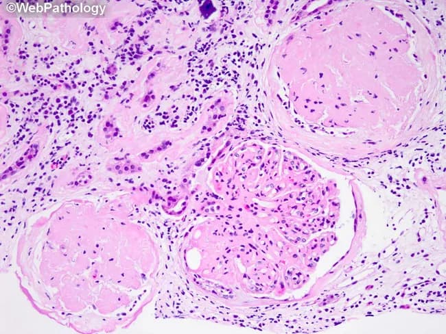 Renal biopsy histology, light microscopy, hematoxylin and eosin stained. Cortex of the kidney showing glomeruli with advanced sclerosis. Two glomeruli are almost completely globally sclerotic, with obliteration of capillary tufts and collapse of the tuft; the third glomerulus demonstrates segmental sclerosis affecting part of the tuft. The tubular compartment shows thickening of the tubular basement membranes, a hallmark of chronic diabetic nephropathy with progressive glomerular basement membrane alterations. The interstitium contains sparse chronic inflammatory infiltrate, composed of mononuclear cells, consistent with chronic tubulointerstitial nephritis accompanying diabetic kidney disease. Overall, there is reduced viable glomerular mass with a pattern of diabetic microvascular injury. The morphological constellation aligns with long-standing hyperglycemia causing mesangial expansion and hyaline arteriolosclerosis; however, nodular mesangial sclerosis (Kimmelstiel-Wilson nodules) is not clearly described in this field. The diagnostic significance lies in confirming diabetic nephropathy with advanced sclerosis, correlating with decreased GFR and proteinuria. This histologic pattern suggests poor renal prognosis and is commonly observed in patients with prolonged diabetes. Clinically, this image is relevant for nephrology, pathology, and medical education, illustrating end-stage renal manifestations of diabetes and guiding therapeutic decisions such as renin-angiotensin system blockade and glycemic optimization. Potential differential diagnoses include hypertensive nephrosclerosis and focal segmental glomerulosclerosis in the appropriate clinical context.