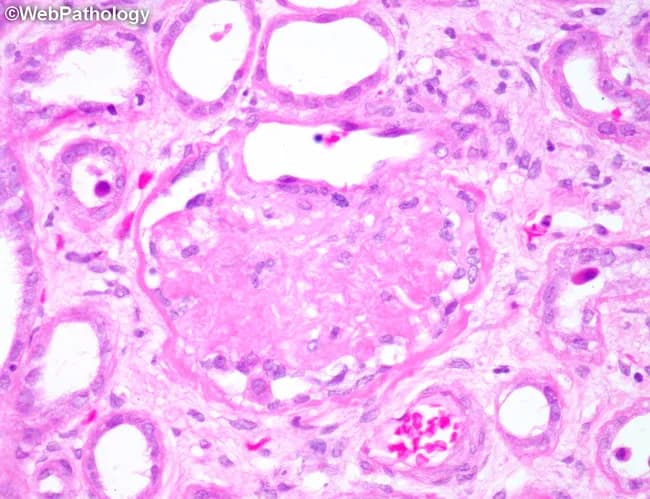 Renal cortical biopsy by light microscopy with Hematoxylin and Eosin staining. The image shows a globally sclerotic glomerulus surrounded by atrophic tubules within the renal cortex. The sclerotic tuft demonstrates obliteration of capillary lumina with increased mesangial matrix; tubulointerstitial compartment shows tubular atrophy and mild interstitial fibrosis. Vascular changes include hyaline arteriolosclerosis of small arteries and arterioles, compatible with chronic nephrosclerosis from long-standing hypertension. No acute inflammatory infiltrates or crescents are observed. This pattern is characteristic of benign hypertensive nephrosclerosis and contrasts with diabetic nephropathy or inflammatory glomerulonephritis. The accompanying tubules atrophy underscores chronic ischemic injury and reduced nephron mass. Clinically, such histology correlates with progressive decline in glomerular filtration rate (GFR), potential proteinuria, and risk of chronic kidney disease progression. Differential considerations include ischemic nephropathy due to vascular disease, age-related nephrosclerosis, and secondary hypertensive kidney injury. Understanding this morphology aids in etiologic assessment of CKD and guides management focusing on blood pressure control and renal protective strategies. This image is valuable for pathology education, nephrology training, and research on hypertensive vascular injury in the kidney. This pattern is commonly seen in chronic hypertensive patients.