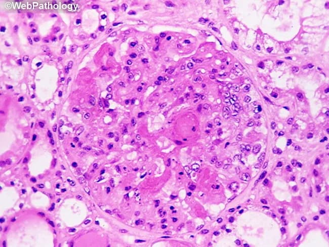 This is a renal histology image prepared for bright-field light microscopy using Martius Scarlet Blue (MSB) staining to identify fibrin deposition in a glomerulus from a renal biopsy. The primary focus is the glomerular tuft within the renal cortex, with the vascular capillary loops showing pink, homogenous, acellular material consistent with fibrin. MSB staining highlights fibrin in red, collagen in blue, and erythrocytes in yellow, enabling precise discrimination of fibrinous thrombi from other extracellular matrix components. Morphologically, the glomerulus demonstrates endothelial swelling with capillary loop thrombosis and partial or complete disruption of the glomerular basement membrane, aligning with malignant nephrosclerosis changes. The noted fibrin deposition corresponds to segmental necrosis and a pattern of acute vascular injury characteristic of hypertensive emergencies. Clinically, such findings support a diagnosis of malignant hypertension-related nephrosclerosis and differentiate it from other glomerulopathies such as thrombotic microangiopathy or immune complex glomerulonephritis. The image thus provides essential diagnostic context, pathophysiologic correlation, and educational value for nephrology, renal pathology, and medical trainees. Potential uses include reference in pathology atlases, teaching slides, and AI-assisted image retrieval for hypertensive renal disease research. Correlation with clinical history of hypertension and kidney injury enhances diagnostic confidence and informs prognosis and management.
