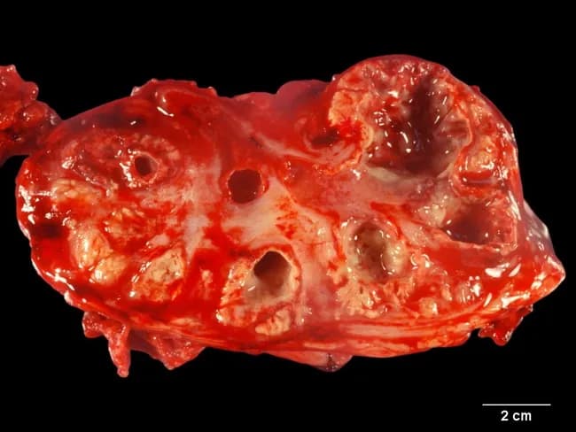 Imaging modality: Gross pathology photograph of a partial renal specimen, with a transverse cross-sectional cut showing dilated calyces and renal pelvis. The renal collecting system walls are thickened and irregular, with multiple yellow nodules protruding into the calyces and parenchyma, consistent with xanthogranulomatous pyelonephritis (XGP). The tissue is reddish-brown with mottled yellowish tan nodules representing foamy macrophage-rich granulomatous inflammation. The scale bar indicates 2 cm, helping gauge the extent of calyceal dilatation and nodular involvement. The gross image demonstrates kidney with caliectasis and involvement of the collecting system, often accompanied by chronic inflammatory destruction, parenchymal atrophy, fibrosis, and stone burden not clearly seen in this slice. XGP is typically linked to long-standing infection and obstruction, nephrolithiasis, and chronic pyelonephritis. The nodular yellow masses reflect lipid-laden macrophages (foam cells) and granulomatous inflammation replacing normal renal tissue. Clinically, this finding suggests destructive inflammatory process rather than a primary renal tumor; management may require nephrectomy. Radiologic correlation (CT: bear's paw sign) and histopathology confirm diagnosis, noting foamy histiocytes, Touton giant cells, cholesterol clefts. Differential considerations include chronic pyelonephritis, renal abscess, and renal cell carcinoma. This image is valuable for educational demonstration of XGP gross morphology and for surgical pathology education and radiology-pathology correlation.