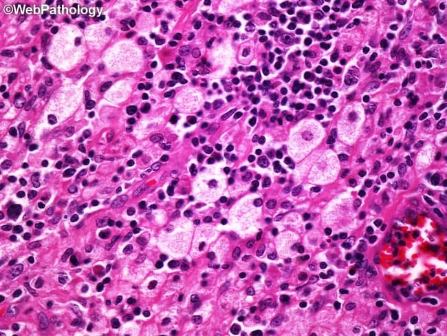 Light microscopy on hematoxylin and eosin (H&E) stained renal tissue illustrating the characteristic xanthogranulomatous pyelonephritis pattern. Renal parenchyma with focal involvement of the renal pelvis and calyces, reflecting chronic suppurative infection of the kidney. The image shows numerous foamy (lipid-laden) histiocytes arranged in aggregates within a background of mixed chronic inflammatory infiltrate comprising lymphocytes and plasma cells; scattered multinucleated giant cells are present with areas of necrosis and fibrous scarring. Lipid-rich macrophages impart a yellow-white appearance at gross inspection, corresponding to the xanthogranulomatous reaction. Additional features may include cholesterol clefts, dilated tubules, and focal nephron destruction; conspicuous vascular congestion and pigment deposition are not prominent. This histology is highly suggestive of Xanthogranulomatous Pyelonephritis; differential considerations include malakoplakia and renal abscess, but the combination of foamy histiocytes with granulomatous inflammation is characteristic. Clinical correlation with chronic obstruction, nephrolithiasis, and infection by uropathogens such as Proteus or Escherichia coli supports diagnosis and informs management, which frequently involves nephrectomy. Clinically, this pattern aids decision-making in chronic kidney infection workups, educational histology resources, and radiologic-pathologic correlation studies for renal masses and obstructive disease. This specimen illustrates the diagnostic hallmark of XGP and underscores the importance of correlating gross appearance with microscopic granulomatous lipid-laden macrophages for accurate pathology reporting.