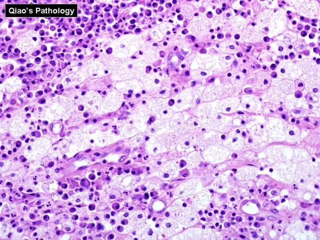 Histopathology image of renal parenchyma demonstrating xanthogranulomatous pyelonephritis on light microscopic examination. Imaging modality: light microscopy of Hematoxylin and Eosin stained sections of renal tissue reveal dense interstitial infiltrates composed of lipid-laden foamy histiocytes intermingled with chronic lymphoplasmacytic inflammation. The foamy macrophages dominate the architectural landscape and contribute to the characteristic yellow‑white gross appearance seen clinically. Multinucleated giant cells and occasional cholesterol clefts may be present within the inflammatory granulomas. The tubulointerstitial destruction is variable, with atrophic tubules surrounded by fibrous stroma and extensive macrophage infiltration replacing normal parenchyma. The pattern reflects a chronic obstructive process often associated with obstructive uropathy and recurrent infection. Diagnostic significance lies in distinguishing xanthogranulomatous inflammation from suppurative pyelonephritis and malignant processes; the presence of lipid-laden histiocytes and a granulomatous lymphoplasmacytic milieu supports XGP. Differential considerations include malakoplakia, chronic pyelonephritis without lipid macrophages, and rare renal tumors with granulomatous reaction. Clinically, histology correlates with destructive renal involvement and guides definitive management, typically nephrectomy in extensive disease. This image serves educational purposes for pathology trainees, radiology-pathology correlation exercises, and research into inflammatory renal diseases. The hue observed corresponds to lipid-rich macrophages; immunohistochemical stains (CD68) may aid confirmation. This image emphasizes macrophage-rich granulomatous inflammation in XGP pathology.