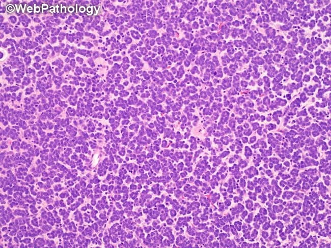This is a histopathology image obtained from renal tumor tissue stained with Hematoxylin and Eosin (H&E) and viewed under light microscopy. The specimen corresponds to metanephric adenoma of the kidney, characterized by embryonal-appearing epithelial cells arranged in tightly packed small tubules. The tubules are commonly separated by scant acellular stroma that may be hyalinized or edematous. Lumina are abortive or extremely small, giving a primitive appearance evocative of developing metanephric tubules; in about one third of cases substantial hyalinizing stroma underscores tubule separation. The tumor cells display uniform, round to oval nuclei with scant cytoplasm and high cellular density, producing a solid to microtubular architectural pattern. The histology mimics primitive Wilms tumor and other embryonal renal neoplasms, raising differential diagnosis challenges. Important diagnostic features include the tubular architecture mimicking metanephric development, minimal cytologic atypia, and the presence or absence of conspicuous stromal components. Immunohistochemical stains and molecular testing may aid distinction from Wilms tumor, but routine H&E features often suffice when kidney-specific patterns are observed. Clinically, accurate recognition of metanephric adenoma is essential because prognosis is excellent after nephron-sparing surgery and overtreatment for a malignant pediatric neoplasm is avoided. This image is valuable for educational, diagnostic, and research contexts in renal pathology.