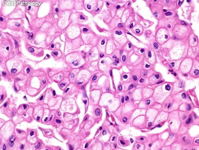 This is a histopathology slide of thyroid tissue prepared by hematoxylin and eosin staining, examined under brightfield light microscopy at high magnification. The specimen demonstrates epithelial neoplasm consistent with papillary thyroid carcinoma (PTC). The neoplastic cells are arranged in sheets and, where present, papillary fronds with fibrovascular cores are recognizable. The predominant cytoplasm is finely reticular and eosinophilic, with blander nuclear features. The nuclei show characteristic raisinoid appearance with nuclear grooves, giving an Orphan Annie eye look; the nuclear membranes are distinct and often thickened. Perinuclear halos, i.e., clear nuclear clearing around the chromatin, are evident. Some tumor cells exhibit voluminous cytoplasm, and in the plane of section, nuclei may be absent in those cells, a phenomenon of sectioning rather than true anuclear cells. The cytoplasmic clearing and grooves are diagnostic, aiding differentiation from benign nodules. The histology carries diagnostic significance, with PTC carrying generally favorable prognosis but potential for lymphatic metastasis; differential includes follicular carcinoma, medullary carcinoma, Hashimoto-related changes, and benign adenomas. Clinically, presence of these features correlates with occult metastasis risk and guides surgical planning, post-operative radioiodine therapy considerations, and molecular testing (e.g., BRAF V600E). This image is relevant for medical education, pathology teaching files, digital atlases, and research on thyroid cancer morphology.