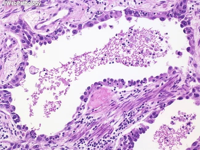 This is a high-power brightfield light microscopy image of a formalin-fixed tissue section stained with Hematoxylin and Eosin. The specimen reveals a small- to medium-sized vessel with luminal content dominated by eosinophilic, granular material compatible with fibrin or organized thrombus. The vessel wall shows minimal intimal thickening and surrounding perivascular tissue contains a mixed inflammatory infiltrate, including scattered neutrophils and lymphocytes, with occasional spindle-shaped fibroblasts indicative of early fibrous remodeling. The mucosal or epithelial architecture surrounding the vessel is not clearly defined, but adjacent stroma demonstrates increased cellularity and edema. There is no overt malignant epithelial proliferation evident in this field. The overall pattern is suggestive of a vascular inflammatory or thrombotic process; features could be compatible with vasculitis, thrombotic microangiopathy, or infectious endovascular involvement, depending on clinical context. No granulomas or necrosis are conspicuously present in this field, though a small focus of macrophage-like cells is seen in the perivascular region. This image supports educational discussions of vascular pathology, thrombus formation, inflammatory vasculopathy, and differential diagnoses in patients with acute or chronic vascular inflammation. The illustrated features emphasize correlation with clinical presentation and laboratory data to distinguish vasculitis from simple thrombosis.