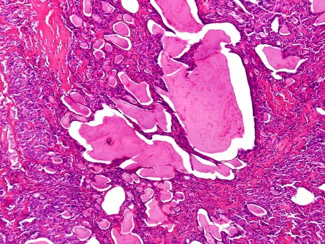 This histopathology image represents renal tissue involved by metastatic thyroid carcinoma, prepared as a hematoxylin and eosin stained slide and examined under light microscopy. The renal cortical/parenchymal field contains variably sized follicles filled with colloid‑like material, features that mimic thyroid follicles. The left side shows microfollicles with abortive lumens and solid appearance, consistent with a thyroid‑type neoplasm invading renal parenchyma. The architectural pattern is compatible with papillary or follicular thyroid carcinoma morphology, including follicle‑forming tumor cells arranged in microacini and acinar clusters amidst desmoplastic stroma. Distinguishing between a primary renal neoplasm and metastatic thyroid carcinoma hinges on immunohistochemical profile and clinical context. If a thyroid primary is confirmed and nuclear features typical of papillary thyroid carcinoma (Orphan Annie eye nuclei, nuclear grooves, grooves/inclusions) are present in metastatic deposits, then immunoreactivity for thyroid transcription factor‑1 (TTF‑1) and thyroglobulin would favor thyroid origin and metastasis. Conversely, a primary renal neoplasm would be unlikely to express TTF‑1 or thyroglobulin. Clinically, recognizing this pattern has implications for staging, prognosis, and treatment, including thyroid cancer‑focused systemic therapy and surveillance for additional metastases. This image underscores the necessity of integrating histology with patient history and immunohistochemistry in diagnostic decision making.