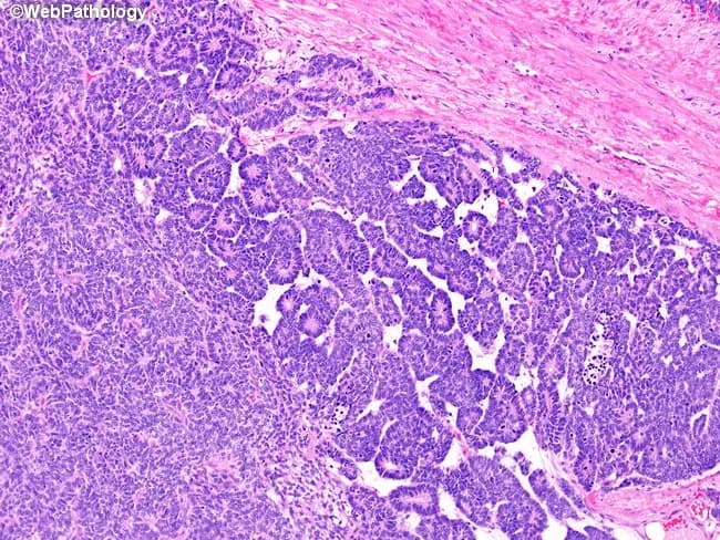 Imaging modality: light microscopy of a formalin-fixed, paraffin-embedded kidney tumor section stained with Hematoxylin and Eosin. Anatomic site: renal parenchyma within a pediatric nephroblastoma (Wilms tumor); imaging perspective: histology micrograph. The tumor exhibits classic triphasic histology with an epithelial component forming papillary structures, a prominent blastemal population arranged in sheets on the lower left, and a primitive fibroblastic stroma occupying the upper right. Epithelial elements resemble abortive tubules and papillae embedded in a cellular, small round blue cell background; blastemal cells are hyperchromatic with scant cytoplasm and high nuclear-to-cytoplasmic ratio. The stroma is variably fibrous, containing loose, spindle-shaped mesenchymal cells. The tumor–stroma interface is relatively well circumscribed in this field, with focal invasion not evident. Immunohistochemistry is not provided; in Wilms tumor, WT1 expression may be variable across components, and morphological context is essential for diagnosis. Clinically, this histology supports nephroblastoma, guiding pediatric management with nephrectomy and multimodal therapy (chemotherapy, and occasionally radiotherapy). Differential considerations include other pediatric renal neoplasms with epithelial differentiation or blastemal-predominant variants. Recognizing triphasic architecture and cellular morphology is critical for diagnostic accuracy, risk stratification, and treatment planning in pediatric renal oncology. These features confirm Wilms tumor.