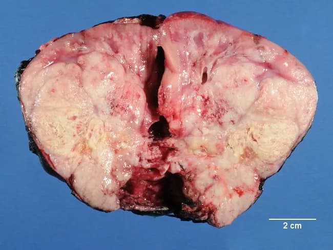 Renal mass, gross pathology photograph of a resected pediatric kidney with an intraparenchymal neoplasm. Modality: Gross pathology; Coronal/transverse cut surface. The kidney shows a large, soft, pale tan to pink mass replacing most of the renal parenchyma with heterogeneous appearance due to hemorrhagic and necrotic foci. The lesion is friable and poorly circumscribed relative to the surrounding cortex, with indistinct margins and occasional satellite nodules evident on the cut surface. The capsule may be variably thinned or breached at the center. Scale bar indicates 2 cm, illustrating a mass several centimeters in greatest dimension. No visible calcification is apparent in this section. The gross appearance aligns with high-grade renal neoplasms in infancy, most characteristically rhabdoid tumor of the kidney (RTK). RTK typically affects children under 5 years, presents as abdominal mass and/or hematuria, and shows aggressive behavior with early metastatic spread. This image emphasizes the gross phenotype: large, soft, fleshy, hemorrhagic, necrotic intrarenal mass with possible satellite nodules. Clinically, RTK requires prompt genetic workup for SMARCB1/INI1 deficiency and multidisciplinary management. This specimen is valuable for educational discussion of differential diagnoses against Wilms tumor, clear cell sarcoma, and other pediatric renal neoplasms. Useful for pathology curricula and radiologic-pathologic correlation.