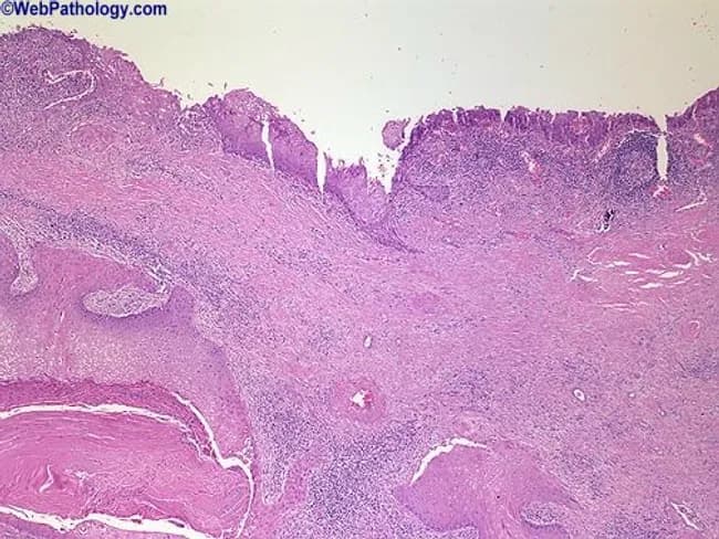 Renal pelvis histology obtained from a urinary tract lesion was imaged using light microscopy on an H&E-stained section. The specimen comprises renal pelvis mucosa lined by urothelium transformed by squamous metaplasia. The surface epithelium is thickened and organized into broad tongues of stratified squamous cells projecting into the underlying lamina propria. The metaplastic epithelium shows typical squamous differentiation with eosinophilic cytoplasm and intercellular bridges; underlying stroma displays mild chronic inflammatory infiltrate. In some areas the squamous epithelium invades the subepithelial tissue, consistent with early invasion rather than a purely reactive change. Normal urothelial architecture is disrupted; transitional epithelium is not intact over the superficial surface. The image highlights a pathologic sequence in which chronic irritation from calculi and infection fosters squamous metaplasia and raises the clinical suspicion for subsequent squamous cell carcinoma of the renal pelvis. Clinically, this pattern is associated with long-standing nephrolithiasis and potential for malignant transformation, particularly in kidneys with anomalous anatomy such as horseshoe kidney. The visualization emphasizes the need for thorough sampling to exclude invasive carcinoma and to guide management, which may include radical nephroureterectomy or targeted therapy depending on invasion depth and staging. This image thus serves educational and diagnostic utility in urologic oncology, nephrology, and surgical pathology.