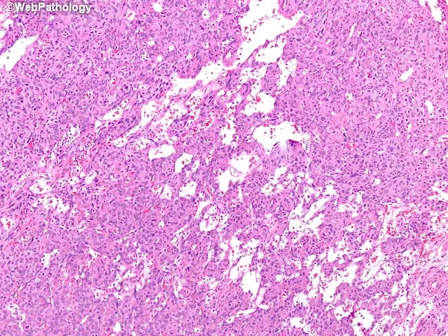 This is a high-vascular renal tumor histology image captured from a hematoxylin and eosin-stained section of Juxtaglomerular cell tumor (JGCT) of the kidney. The slice demonstrates densely packed, monomorphic tumor cells with uniform round to oval nuclei and eosinophilic cytoplasm arranged in sheets and cords. Interspersed small venules and muscular arterioles create a conspicuous vascular network; branching, stag-horn–type vessels resembling hemangiopericytoma are a salient feature. The tumor arises from juxtaglomerular cells of the afferent arteriole in the juxtaglomerular apparatus, a specialized smooth muscle lineage that normally regulates blood pressure via renin release. The neoplasm is typically well circumscribed and highly vascular, with scant cytoplasm and minimal pleomorphism, which helps distinguish it from renal cell carcinoma and other hypervascular renal lesions. Clinically, JGCT often presents with secondary hypertension due to renin secretion and is considered benign or indolent; surgical excision or nephron-sparing approaches are curative in many cases. Immunohistochemical or molecular testing may show renin expression in tumor cells, supporting diagnosis. For education and research, this image demonstrates characteristic vascular patterns, including stag-horn vasculature and perivascular monotony, enabling recognition of renin-producing renal neoplasms on histology slides. This image is educational for pathologists, clinicians, and trainees, and aids differential diagnosis and management.