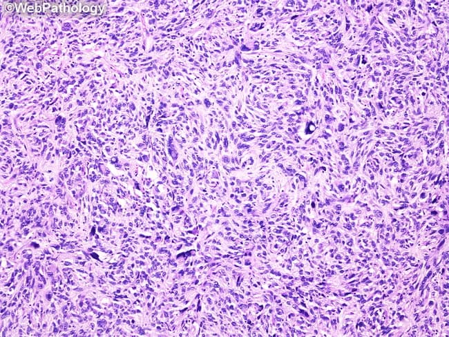 Imaging modality: Light microscopy of Hematoxylin and Eosin–stained renal tumor tissue section, bright-field microscopic view of a storiform-pleomorphic spindle cell neoplasm arising in the kidney. Precise anatomic localization: renal parenchyma (kidney cortex/medulla) with involvement of perivascular stroma. Morphologic features: sheets and short fascicles of plump spindle cells arranged in a storiform (cartwheel) pattern around small-to-medium blood vessels; prominent cellular pleomorphism with irregular, hyperchromatic nuclei; abundant mitotic figures including atypical mitoses; admixed inflammatory cells, notably lipid-laden macrophages (xanthoma cells); background myxoid change may be present; necrosis may be focal in higher grade areas. Immunophenotype is variable; tumor demonstrates undifferentiated pleomorphic sarcoma pattern rather than lineage-specific differentiation; differential diagnosis includes sarcomatoid renal cell carcinoma, fibrosarcoma, malignant fibrous histiocytoma (older term), leiomyosarcoma, and rhabdomyosarcoma. Clinical significance: UPS of the kidney is aggressive with potential for local invasion and metastasis; diagnosis requires correlation with immunohistochemistry and exclusion of specific lineages. Utility: this histology image is essential for educational demonstration of storiform pattern, spindle cell pleomorphism, xanthoma cells, and mitotic activity in renal UPS; useful for pathology teaching, differential diagnosis discussions, and research on soft tissue sarcomas of renal origin. This image also exemplifies the fibrous stroma and inflammatory milieu that may complicate grading.