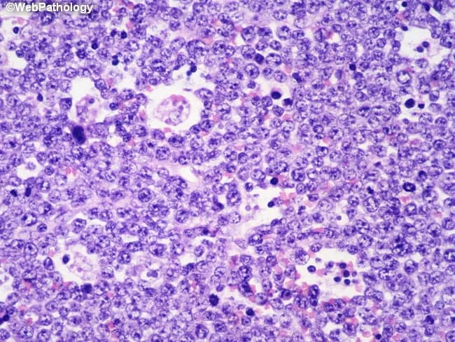 Imaging modality and technique: Light microscopy of hematoxylin and eosin stained renal tissue section. The specimen reveals a densely cellular infiltrate composed of medium-sized lymphoid cells with round to oval nuclei, finely clumped chromatin, and multiple nucleoli. The tumor cells are arranged in diffuse sheets with high mitotic activity and numerous apoptotic figures. Interspersed histiocytes actively phagocytose apoptotic debris, producing scattered tingible-body macrophages that contribute to a characteristic 'starry-sky' pattern. In addition to uniform cytology, occasional mitotic figures are evident, underscoring the tumor’s aggressive biology. The background kidney parenchyma shows limited residual tubular architecture, with infiltration disrupting normal architecture. Immunophenotypic context (if tested) would typically show B-cell markers with a very high proliferation index; c-MYC rearrangement is a common molecular feature of Burkitt lymphoma. The lesion is localized within the renal parenchyma, a recognized, though less common, site of extranodal Burkitt lymphoma. Clinically, this histology corresponds to an aggressive B‑cell lymphoma requiring prompt oncologic management; differential considerations include other high-grade B-cell lymphomas (DLBCL), Burkitt-like lymphoma, and lymphoblastic lymphoma. The image is valuable for educational purposes, illustrating classic cytologic features, proliferative activity, and the hallmark starry-sky pattern in a renal presentation. This histology supports rapid diagnosis and urgent multidisciplinary treatment planning.