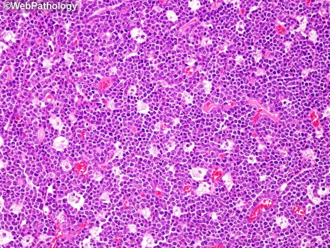 Bright-field light microscopy of a renal biopsy stained with Hematoxylin and Eosin demonstrates infiltration of the renal parenchyma by a uniform population of medium-sized lymphoid cells with high nuclear-to-cytoplasmic ratio, round nuclei, finely dispersed chromatin, and prominent nucleoli. The neoplastic cells arrange in diffuse sheets, with scattered macrophages containing apoptotic debris that create a conspicuous starry-sky pattern. Mitotic activity is brisk, reflecting the high proliferative index typical of Burkitt lymphoma. The background renal architecture is variably preserved but overall shows tumor effacement of the cortex with scant residual tubules. The hallmark starry-sky appearance arises from numerous tingible-body macrophages amid the dense cellularity. Immunophenotype favors mature B-cell lineage: CD19/CD20 positive, CD10 and BCL6 positive; Ki-67 nearly 100% underscores extreme proliferative rate. Cytogenetics commonly reveal MYC rearrangement, most often t(8;14)(q24;q32). Clinically, this histology indicates an aggressive, highly chemosensitive non-Hodgkin lymphoma with potential primary renal involvement or secondary infiltration. Differential diagnoses include diffuse large B-cell lymphoma and other high-grade lymphomas, but the extreme proliferative index and starry-sky pattern support Burkitt lymphoma. Management requires prompt systemic therapy, staging, CNS assessment, and molecular testing for MYC rearrangement. This image serves as an educational resource for hematopathology, surgical pathology, and correlates with radiologic assessment.
