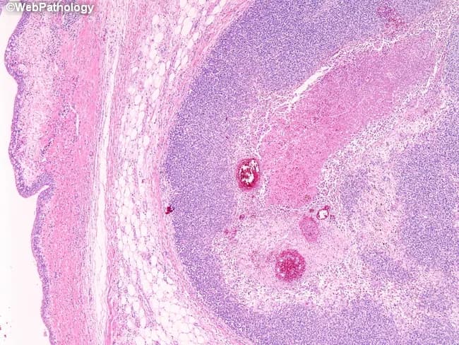 This histopathology image represents a small round blue cell tumor of the renal pelvis, consistent with primitive neuroectodermal tumor (PNET)/Ewing family tumor. Acquired from a renal pelvis specimen showing invasion into the urothelial lining, the section is stained with hematoxylin and eosin and viewed under light microscopy at low to intermediate magnification. The tumor is organized in broad sheets of uniform, round cells with scant cytoplasm and hyperchromatic nuclei, yielding a classic high nuclear-to-cytoplasmic ratio. Mitotic figures are frequent and apoptotic activity may be evident; the surrounding renal parenchyma shows desmoplastic response and focal invasion of the mucosa, with the urothelium on the left preserved in outline. The lesion’s morphology mirrors other Ewing sarcoma family tumors and underlines the close morphologic and genetic kinship to EWSR1-associated neoplasms. Immunophenotyping (where performed) would typically show CD99 (MIC2) expression and may reveal EWSR1 gene rearrangement (e.g., EWSR1-FLI1) by molecular testing. Clinically, such tumors are aggressive and require multidisciplinary management. This image highlights the diagnostic significance of recognizing small round blue cell morphology in the renal pelvis, differentiating from Wilms tumor, lymphoma, rhabdomyosarcoma, and neuroblastoma, and underscores the role of histology complemented by molecular diagnostics for accurate classification and staging.