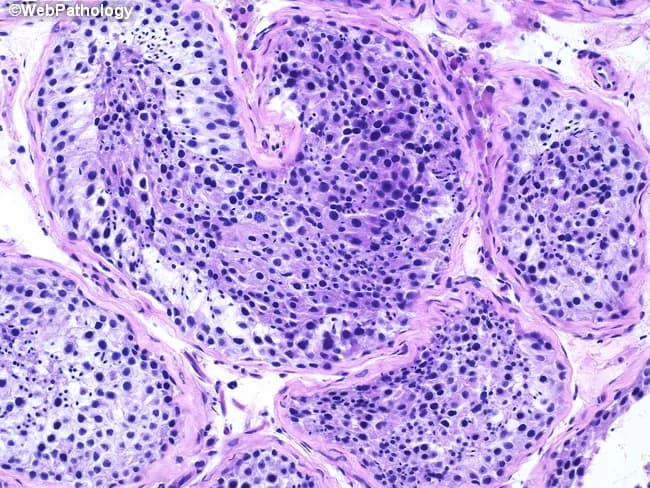 This histopathology image depicts a testicular biopsy prepared for light microscopy. Using Hematoxylin and Eosin (H&E) staining, the tissue reveals multiple cross-sections of seminiferous tubules with preserved architecture and active germ cell maturation. The tubules show intact basal membranes and orderly germinal epithelium containing all stages of spermatogenesis. Within several tubules, spermatogonia lie adjacent to the basement membrane, followed by primary spermatocytes in prophase I, round and elongated spermatids, and mature spermatozoa occupying tubule lumina in places, consistent with complete spermatogenic effort. Sertoli cells provide supportive scaffolding, appearing columnar with prominent nuclei. Interstitium between tubules contains connective tissue and rare Leydig cells without overt inflammation or fibrosis. Overall, there is no evidence of tubular sclerosis, hyalinization, maturation arrest, or neoplastic processes. The image emphasizes normal histology with germ cells at multiple maturation stages and intact tubule integrity.

Clinically, such a biopsy supports normal spermatogenic function and fertility potential, assuming no systemic hormonal disturbances. The finding argues against major gonadal causes of infertility such as Sertoli cell-only syndrome or spermatogenic failure. In practice, results correlate with normal semen parameters and typical serum testosterone, FSH, and LH profiles, guiding management toward non-testicular etiologies if infertility persists. This description highlights the diagnostic significance of preserved spermatogenesis in evaluating male fertility and testicular pathology.