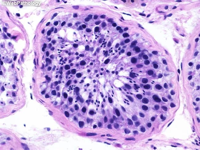 Histology, Testis, Seminiferous tubule, Hematoxylin and Eosin stain, Brightfield microscopy; Cross-sectional view of a seminiferous tubule demonstrates orderly spermatogenesis with a basal germ cell compartment containing spermatogonia, progressing through primary and secondary spermatocytes, round and elongated spermatids, to mature spermatozoa in the tubule lumen. The germinal epithelium exhibits a concentric arrangement along the basement membrane with Sertoli cells interspersed, providing nourishment and structural support. Notable features include intact basement membrane, high cellular density, and a full spectrum of germ cell stages, indicating active spermatogenic activity and normal testicular histology. Pathology domain features: tissue architecture; cellular morphology; luminal maturation; presence of multiple germ cell types at defined maturation stages. Diagnostic significance lies in confirming fertility potential and serving as a baseline for infertility workups or post-therapy monitoring. Differential considerations include maturation arrest and Sertoli cell-only patterns if germ cells are absent or arrested. Clinically relevant for urology, andrology, reproductive endocrinology, and pathology education; suitable for radiology-pathology correlation, histology textbooks, and medical education.