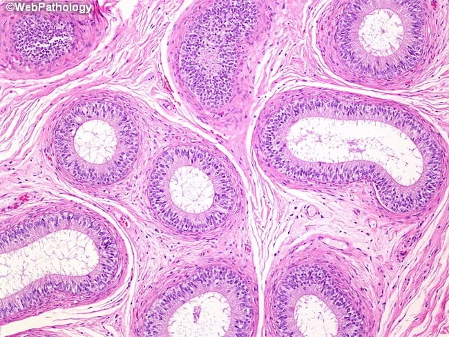 Imaging modality: Light microscopy of a formalin-fixed epididymal tissue section stained with Hematoxylin and Eosin (H&E). Anatomical context: Epididymis of the male reproductive tract, examining tubules that represent the head, body, and tail regions. Core histology: Tubules are lined by tall, pseudostratified columnar epithelium with apical cilia; the epithelial cells include dark-staining columnar cells and basal cells, with occasional clear cells. The lumina are widened and irregular, containing little luminal debris. The tubules sit within a thick tunica muscularis externa composed of multiple concentric smooth muscle layers, which supports peristaltic movement of sperm. Surrounding stroma is relatively loose with fibroelastic connective tissue. The mucosae display intact polarity, with nuclei oriented basally and apical margins bearing dense cilia. This image captures typical epididymal architecture: a specialized tall epithelium, narrow lumens, and a prominent muscular coat essential for sperm maturation, concentration, and propulsion. Pathologic deviations to this pattern would include epithelial desquamation, loss of ciliation, basement membrane disruption, or inflammatory infiltrates. Clinical relevance: normal epididymal histology demonstrates coordinated epithelial activity and smooth muscle contractility; findings aid education in male reproductive pathology, histology teaching, and differential diagnosis of scrotal pathology. In educational databases, this image enhances recognition of epididymal histology.