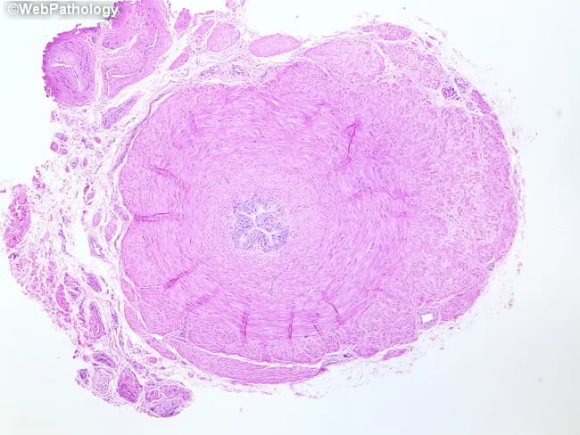 Comprehensive description (approx 200 words): This image depicts a transverse histologic cross-section of the ductus deferens (vas deferens) from the human male reproductive tract, prepared on a hematoxylin and eosin stained slide and viewed with microscopy. The structure is a single, rounded duct with a conspicuously thick muscular wall reflecting the muscularis externa, which in this region comprises inner longitudinal, middle circular, and outer longitudinal muscle layers. The mucosal surface lines a narrow lumen; in classic vas deferens histology, the mucosa is lined by tall pseudostratified columnar epithelium with stereocilia, though the epithelial detail may be partially compressed in this section and not readily visualized. The surrounding stroma shows dense connective tissue and occasional smooth muscle fibers; a well-developed periductal vascular network may be present in the resolved plane. This duct arises embryologically in the male, transports spermatozoa from the epididymis to the ejaculatory duct, and measures roughly 30–40 cm in vivo; histology here emphasizes architecture over content. Clinically, the duct is relevant to fertility and vasectomy planning, since obstruction or scarring can impair sperm transport. This image serves as a reference for normal ductal anatomy, layering, and epithelial morphology, and is useful in educational settings (anatomy, histology, pathology) for learning identification and differential diagnosis within the male reproductive tract.