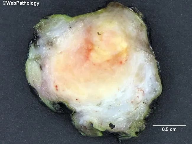 Gross pathology photograph of an enlarged epididymis sectioned in cross-section to reveal a pale, central area of caseous necrosis bordered by dense fibrous tissue. This macroscopic appearance is typical of tuberculous epididymo-orchitis, reflecting granulomatous inflammation with central caseation. The specimen represents epididymal tissue from the male genitourinary tract, captured as a gross cross-section for macroscopic assessment. Peripheral fibrosis surrounds the necrotic center, with granulomatous infiltrate evident at the margins in a pattern compatible with tuberculosis. In tuberculosis, additional involvement of the prostate, kidney, or urinary tract is common, and concomitant pulmonary TB may be present. Clinically, patients may have mild symptoms such as scrotal pain and enlargement rather than overt systemic illness. When microscopic sections are available, histology would show granulomas with caseating necrosis and Langhans-type giant cells. This image is valuable for differential diagnosis of scrotal masses and for guiding TB workup and anti-tuberculous therapy. Scale bar indicates 0.5 cm, highlighting the small size of the specimen despite pronounced gross pathology. This cross-sectional view serves as an educational reference for surgical pathology and radiology-pathology correlation in men’s health. Recognizing tuberculous epididymo-orchitis early reduces diagnostic delay and improves likelihood of targeted antimicrobial treatment. Correlate with patient history and chest imaging.