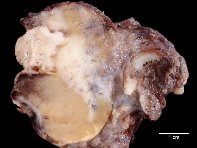 This is a macroscopic gross pathology photograph of the scrotal contents from a 25-year-old male with acute epididymo-orchitis in the setting of suspected testicular torsion. The specimen demonstrates destruction of the epididymal architecture with extensive inflammatory changes and partial involvement of the adjacent testicular parenchyma. The epididymis is irregular and disrupted, with creamy white exudate and pale tan to yellowish areas representing inflammatory tissue and early necrosis. The testicular surface shows uneven contour and focal inflammatory involvement; surrounding tunica and vascular structures may be congested. A 1 cm scale bar provides reference for lesion size. The overall appearance is that of an intense infectious/inflammatory process rather than isolated torsion, although torsion could be clinically suspected preoperatively. Such gross findings reinforce the diagnostic challenge of acute scrotal pain, where epididymo-orchitis can mimic torsion and lead to urgent surgical exploration. This image is valuable for medical education, urology training, and pathology teaching as a representative example of acute epididymo-orchitis with epididymal destruction and partial testicular involvement. Keywords: epididymitis, orchitis, acute inflammation, scrotal infection, gross pathology, pathology education, differential diagnosis, testicular torsion mimic, Pathorama.ch, 25-year-old male. These features are typical of acute inflammatory epididymal and testicular involvement.