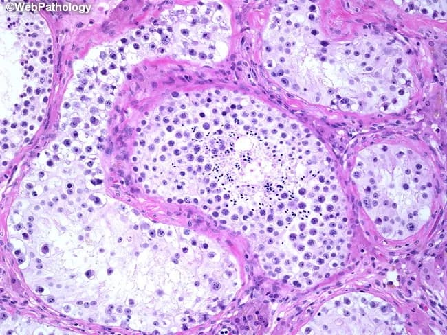 This histopathology image is a Hematoxylin and Eosin (H&E) stained light microscopy section of testicular tissue, illustrating intratubular germ cell neoplasia in situ (GCNIS) alongside a morphologically normal seminiferous tubule showing active spermatogenesis. The specimen is testicular parenchyma, prepared as a paraffin-embedded section, with transverse sections through multiple tubules. The central tubule demonstrates ongoing germ cell maturation and spermatogenesis, characterized by orderly germ cells and prominent spermatogenic cords. Surrounding tubules, however, contain neoplastic germ cells confined to the tubule basement membranes, consistent with GCNIS; these cells typically exhibit enlarged, relatively uniform nuclei, increased nuclear-to-cytoplasmic ratio, and conspicuous nucleoli, with disruption of normal maturation. Notably, there is no invasion into the interstitium or vasculature evident in this field. Clinically, GCNIS is a premalignant lesion with a high propensity to progress to invasive testicular germ cell tumors, especially when bilateral involvement is present. Management varies: unilateral GCNIS commonly necessitates orchiectomy, whereas bilateral disease may be treated with low-dose external beam radiotherapy to preserve testicular tissue and hormonal function. The image underscores the importance of correlating histology with clinical strategy, surveillance, and fertility considerations in germ cell neoplasia. Further histologic context includes assessment for invasion and ancillary markers as clinically indicated.