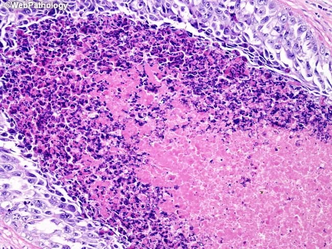 This histopathology image depicts a testicular parenchymal cross-section stained with Hematoxylin and Eosin, viewed under light microscopy. The center displays eosinophilic coagulative necrosis with preserved albeit blurry architectural outlines, surrounded by a dense inflammatory cell infiltrate including lymphocytes and plasma cells. The necrotic zone often undergoes dystrophic calcification, evidenced by granular basophilic to pale pink calcified deposits at the periphery. Notably, intratubular coarse calcification is seen within scarred tubules in the surrounding parenchyma, a pattern associated with burnt-out or regressed germ cell tumor. The viable tumor component, if present, is not conspicuous in this field, supporting regression rather than active embryonal carcinoma. The sample typifies a burnt-out germ cell tumor scenario rather than a primary inflammatory lesion, though eosinophilic necrosis is not pathognomonic for embryonal carcinoma. Clinical significance includes the possibility of regression, calcification, and residual scar; differential diagnoses include burnt-out seminoma or nonseminomatous germ cell tumor. This image provides diagnostic clues for pathologists when correlating histology with tumor markers and imaging studies. Potential clinical use cases include educational illustration of tumor regression, biopsy interpretation, and differential diagnosis in testicular germ cell neoplasia. Educational relevance spans pathology education, urologic oncology, and radiologic-pathologic correlation in burnt-out testicular germ cell neoplasia.