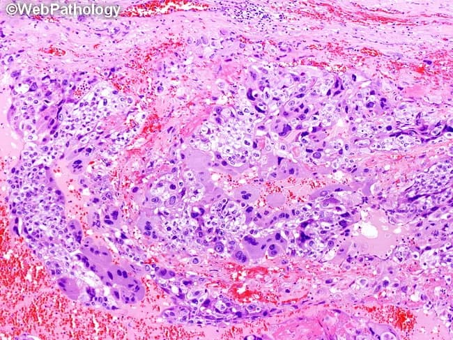 Light microscopy histology of a gestational trophoblastic neoplasm, specifically choriocarcinoma, using hematoxylin and eosin staining. The sampled tissue from the uterus shows a biphasic trophoblastic proliferation with intermixed cytotrophoblasts and syncytiotrophoblasts embedded in a hemorrhagic background. Cytotrophoblasts are mononucleated with clear to pale pink cytoplasm, distinct cell borders, irregular oval to elongate nuclei, prominent nucleoli, and brisk mitotic activity. They form plexiform aggregates and villous-like structures lacking stromal cores. Syncytiotrophoblasts are large, multinucleated or polyploid cells with abundant deeply eosinophilic cytoplasm and nuclei displaying dense, smudgy chromatin; they extend cytoplasmic processes around cytotrophoblast nests and infiltrate clumps of trophoblast. The interplay between these two cell types creates a biphasic architecture characteristic of choriocarcinoma, often accompanied by extensive hemorrhage and necrosis. The tumor lacks organized placental stromal support and shows high cellular pleomorphism and mitotic rate. Clinically, these histologic features support a diagnosis of gestational choriocarcinoma with high malignant potential and propensity for early hematogenous spread. The finding is diagnostic when coupled with elevated serum beta-hCG and pertinent clinical history. Potential uses include confirmation of diagnosis, prognostic assessment, and guidance of chemotherapy regimens for GTN. The description also informs differential considerations from PSTT or epithelioid trophoblastic tumor. Staging.