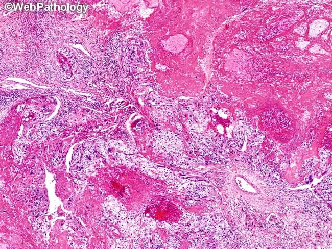 Histopathology image, prepared as a hematoxylin and eosin (H&E) stained tissue section, depicting choriocarcinoma within endometrial/uterine tissue. The lesion displays islands of viable malignant trophoblastic cells embedded in extensive hemorrhage and coagulative necrosis. Trophoblastic proliferation is biphasic, with cytotrophoblasts forming polygonal nests and clusters and syncytiotrophoblasts showing multinucleated, eosinophilic cytoplasm adjacent to fragile hemorrhagic stroma. Nuclear atypia and brisk mitotic activity are evident in viable foci. The surrounding matrix is fibromyxoid with necrotic debris and residual vascular channels, reflecting aggressive, vascular tumor growth. The lack of well-formed villi distinguishes choriocarcinoma from other gestational trophoblastic lesions. Areas of extensive hemorrhage contribute to the gross appearance of reddish, necrotic tissue in vivo. In immunohistochemistry, tumor cells typically express human chorionic gonadotropin (hCG) and cytokeratins, supporting trophoblastic lineage; p63 or inhibin may be variably positive, depending on subtype. Clinically, this histology corresponds to a highly vascular, metastasis-prone neoplasm that requires prompt evaluation of serum hCG levels and imaging for metastatic disease. The diagnostic significance lies in distinguishing choriocarcinoma from non-neoplastic gestational tissue and other germ cell tumors, guiding management including chemotherapy and monitoring for beta-hCG decline. This image is illustrative for educational reference, highlighting histologic hallmarks and diagnostic pitfalls in trophoblastic neoplasia today.